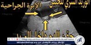 أربعةجلسات لنقل الدم داخل الرحم تنقذ جنينا من أنيميا حادة بمستشفى صحة المرأة بجامعة أسيوط